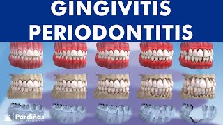 Gingivitis and Periodontitis  Evolution © [upl. by Hanas]