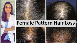 How To Naturally Cure Hairloss  a Receding hairline  and Thinning in 30 days [upl. by Kirenoj294]