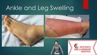 Top 10 causes of Ankle and Leg Swelling [upl. by Elyrpa]