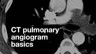 Pulmonary CT Angiogram Basics [upl. by Leak]