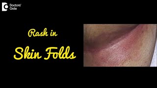 INTERTRIGO  Rash in Skin Folds  Causes Symptoms and Treatment  DrNischal K C  Doctors Circle [upl. by Dosh103]