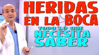 HERIDAS EN LA BOCA AFTAS ORALES  Todo lo que necesita saber  Enfermedades 10 [upl. by Oberheim]