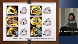 2D Vs 3D TTE for Tricuspid Valve Anatomy [upl. by Dimitris]