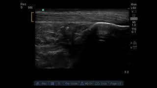 Achilles Tendon Rupture US Annotated JETem 2019 [upl. by Olds]