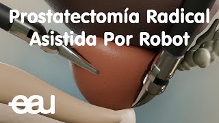 Prostatectomía Radical Asistida Por Robot [upl. by Rattan]