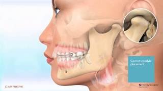 Carriere® Motion™ Appliance for Class II Patient Education Animation 2 [upl. by Sitruk765]