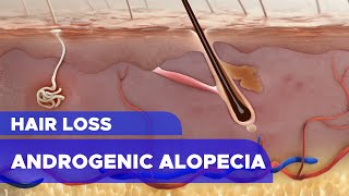 Hair Loss Androgenic Alopecia [upl. by Hanas535]