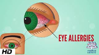 Eye Allergy Causes Signs and Symptoms Diagnosis and Treatment [upl. by Acila591]