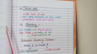 Prostate Carcinoma Pathology  Morphology and Gleason Grading [upl. by Nathanial]