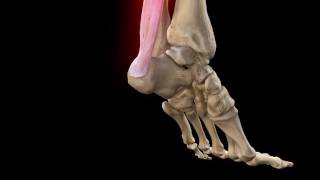 Achilles Tendon Rupture  Complete Anatomy [upl. by Ferren10]