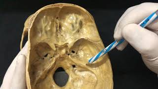 Breaking the Nose  Rhinoplasty Animation  Osteotomy [upl. by Teague96]