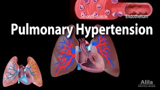 Pulmonary Hypertension Animation [upl. by Kim]