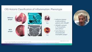 What is allergic rhinitis  Respiratory system diseases  NCLEXRN  Khan Academy [upl. by Callas]