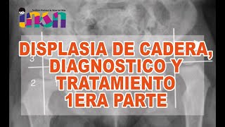 Displasia de Cadera Diagnostico y Tratamiento 1era Parte  Telecapacitaciones INSN [upl. by Erroll]