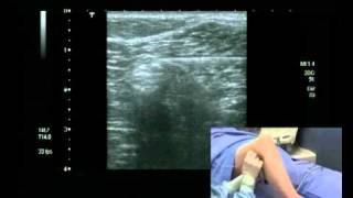 Popliteal Fossa  Boundaries amp Contents  Anatomy Tutorial [upl. by Schoof]