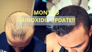 Month 3 ROGAINE RESULTS Minoxidil  Regrowth [upl. by Nomae915]