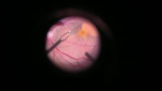 Vitrectomy with internal limiting membrane ILM peeling [upl. by Osbourn]