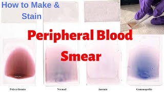 Peripheral Blood Smear Peripheral Smear Examination  Leishmans Staining Procedure [upl. by Anamuj85]