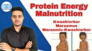 Protein Energy Malnutrition  Kwashiorkor Vs Marasmus [upl. by Haimaj246]