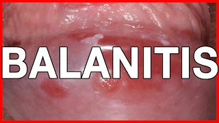 Balanitis Symptoms Causes Treatment and Prevention [upl. by Hsizan]