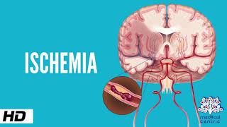 Ischemic Heart Disease in under 2 mins [upl. by Alayne]