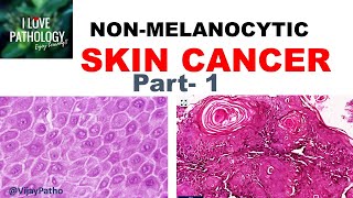 SKIN CANCER Non Melanocytic Part 1 Anatomy Etiopathogenesis amp Classification [upl. by Yrdua]