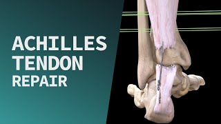 Achilles Tendon Repair [upl. by Merriam]