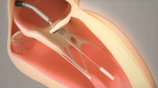 Transcatheter Mitral Valve Chord Repair by Pipeline Medical [upl. by Atem255]