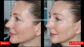 Skin Cancer Treatment Levulan Blue Light  Photodynamic Therapy  My Full Experience [upl. by Lynden151]