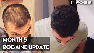 5 Month Rogaine Update Minoxidil  IT WORKS [upl. by Nedgo]