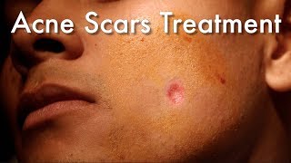 Dermabrasion For Acne Scars [upl. by Sapphera]