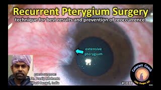 manual SICS cataract surgery with nucleus bisection [upl. by Mihsah380]