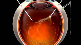 Vitrectomy animation [upl. by Michale165]