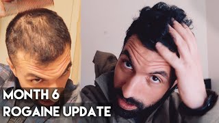 6 Month Rogaine Results Minoxidil [upl. by Berthold]