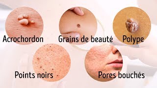 8 Maladies Graves Que Notre Peau Nous Signale [upl. by Aicenod]