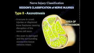 Nerve Injury types  Nerve recovery  Everything You Need To Know  Dr Nabil Ebraheim [upl. by Nohtiek]