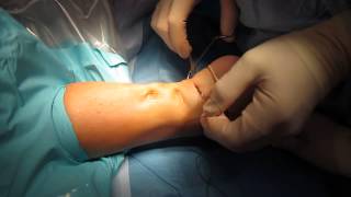 Percutaneous Achilles Tendon Surgery Repair Unedited by Kevin R Stone MD [upl. by Obmar140]