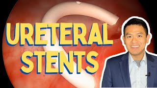 DJ stent stent  Ureteric stent [upl. by Rehpotisrhc51]