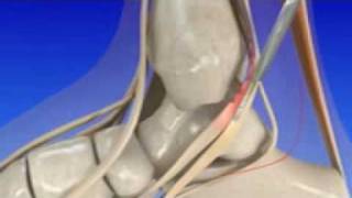 Introduction to Posterior Tibial Tendon Dysfunction [upl. by Ephrayim]