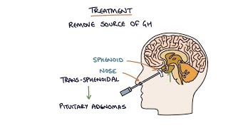 Understanding Acromegaly [upl. by Eetsud202]