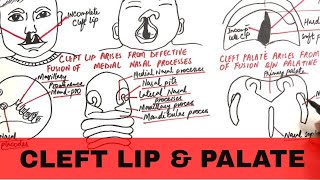 Cleft Palate Speech Error Animations [upl. by Wurst350]