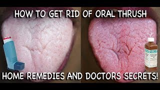 How to Treat Candida at Home Doctors Advice [upl. by Mcadams3]