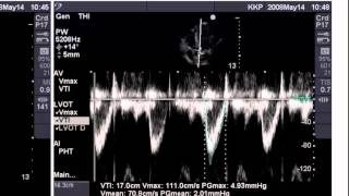 Point of Care Echo Stroke Volume Determination [upl. by Gregrory]