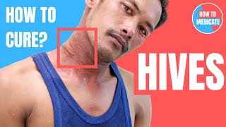 How to treat Hives Urticaria  Doctor Explains [upl. by Casar]