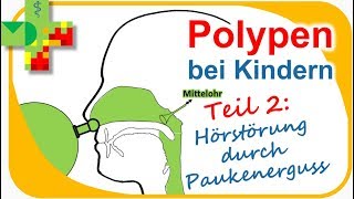 POLYPEN bei Kindern  Teil 2 [upl. by Vally]