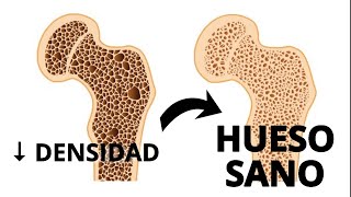 COMO GANAR DENSIDAD OSEA Y PREVENIR OSTEOPOROSIS EN 3 PASOS [upl. by Nitsyrk]