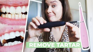 HOW TO REMOVE CALCULUS TARTAR PLAQUE AT HOME  Ultrasonic Tooth Cleaner Review  Does It Work [upl. by Tterej537]