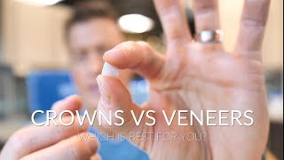 CROWNS VS VENEERS  Which is best [upl. by Nohtahoj]