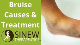 Bruise Causes and Treatment [upl. by Nawj]