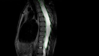 Spinal arachnoid cyst thoracic MRI full image with the Dignosis [upl. by Cressy]